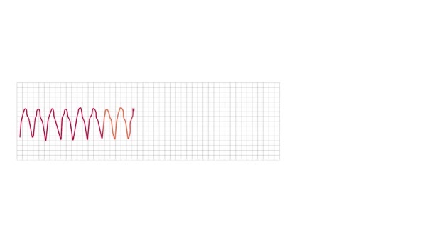 Animated Electrocardiograph Monitor Graph Shows Ventricular Tachycardia Abnormality — Stok video