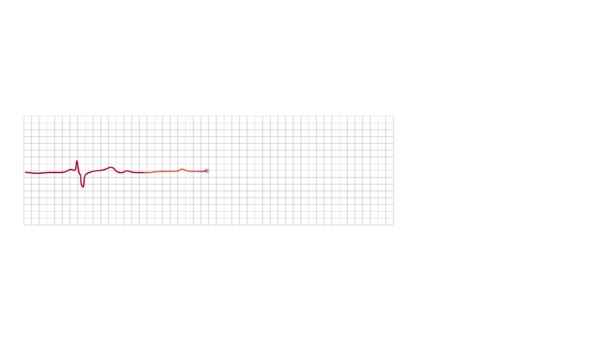 Animated Electrocardiograph Monitor Graph Shows Third Degree Partial Block Abnormality — Stok video