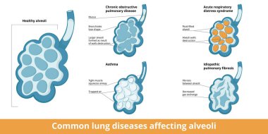 Yaygın alveol hasarı. Akciğer hastalıklarının neden olduğu değişimler: kronik obstrüktif solunum hastalığı, astım, akut solunum zorluğu sendromu ve idiyopatik pulmoner fibroz.