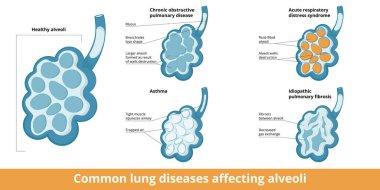 Common alveoli damages. Differences between changes caused by lung diseases: chronic obstructive respiratory disease, asthma, acute respiratory distress syndrome and idiopathic pulmonary fibrosis. clipart