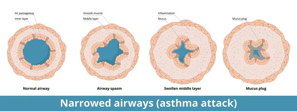 Fasi Delle Vie Aeree Restringimento Durante Attacco Asma Con Possibile — Vettoriale Stock