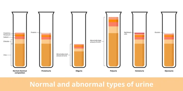 Composición Hemática Normal Orina Sus Tipos Anormales Los Tipos Comunes — Vector de stock