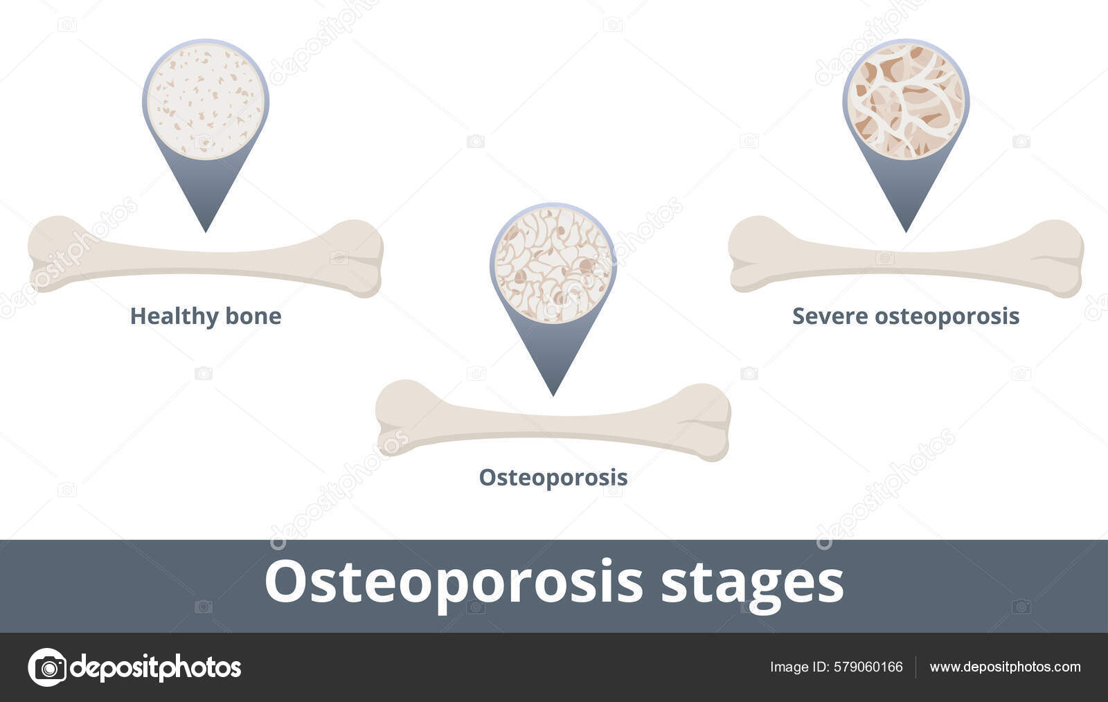Osteoporosis Stages Disease Develops Bone Mineral Density Bone Mass Decrease Stock Vector Image