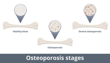 Kemik erimesi aşamaları. Kemik mineral yoğunluğu ve kemik kütlesi azalınca hastalık gelişir. Görselleştirme sağlıklı kemik, osteoporoz ve şiddetli osteoporoz içerir.