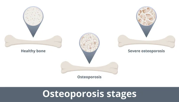 Osteoporose Stadia Ziekte Ontstaat Wanneer Botmineraaldichtheid Botmassa Afnemen Visualisatie Omvat — Stockvector