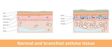 Normal ve bronşiyal astım dokusu. Kadeh hücreleri, pürüzsüz kas, lamina propia ve direk hücreleri de dahil olmak üzere normal ve bronşit astım dokuları arasındaki farkın görselleştirilmesi.