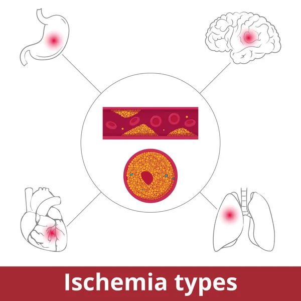 Ischemia Types Visualization Restriction Blood Supply Caused Problems Blood Vessels — Vector de stock