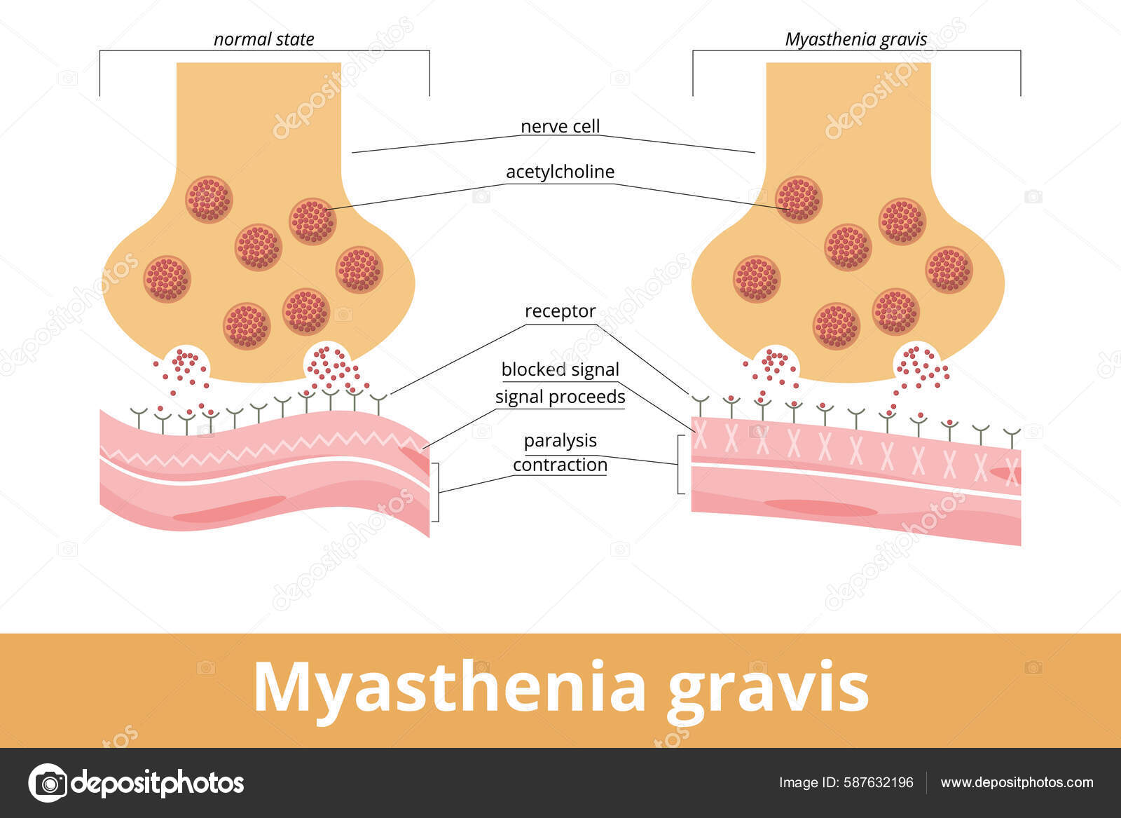 Myasthenia Gravis Autoimmune Disease Neuromuscular Junction Antibodies Block Destroy Nicotinic