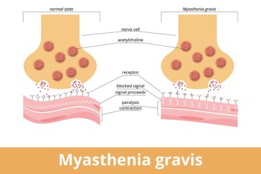 Myasthenia gravis. Antikor sinir ve kas arasındaki bağlantı noktasında nikotinik asetilkolin reseptörlerini (AChR) engellediğinde veya yok ettiğinde oluşan otoimmün sinir sistemi hastalığı..