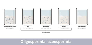 Oligospermia, azoospermia. Sağlık durumunu tanımlayan sperm sayısının görselleştirilmesi: sağlıklı sperm sayısı, orta veya şiddetli oligospermi veya yokluğu.