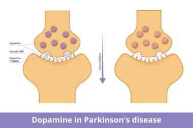 Parkinson hastalığında dopamin. Parkinson hastalığına yakından bağlı nörodejenerasyon nedeniyle dopamin üretiminin görselleştirilmesi azalıyor.