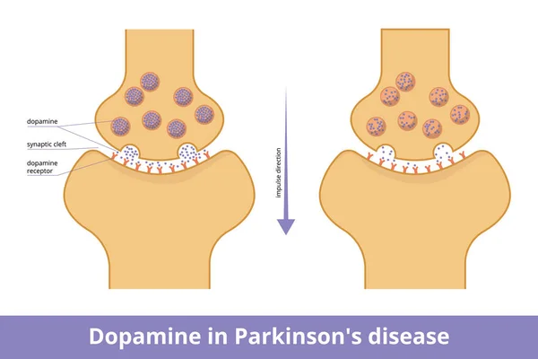 Dopamine Parkinson Disease Visualization Dopamine Production Decrease Due Neurodegeneration Closely — Vetor de Stock