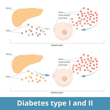Diabetes type I and II. Schematic visualization of two diabetes types: type one (pancreas does not produce insulin) and type two (cells are unable to use it).