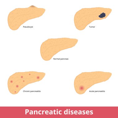 Pancreatic diseases. Visualization of common pancreatic diseases including pseudocyst, tumor, chronic and acute pancreatitis.