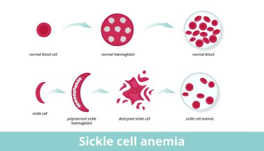 Orak hücre anemisi. Orak hücre anemisi (hastalık), eritrositin yuvarlak şeklini bozan uzun polimerize orak hemoglobine zarar veren orak hücrelerden kaynaklanır..