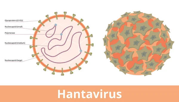 Ortohanta Virüsü Nsanlardaki Hantavirüs Enfeksiyonları Renal Sendrom Hfrs Hantavirüs Pulmoner — Stok Vektör
