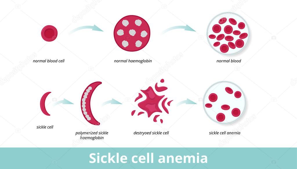 Sickle cell anemia. Sickle cell anemia (disease) occurs due to sticky sickle cells damaged long polymerized sickle haemoglobin that distorts erythrocyte round shape.