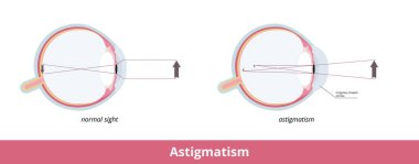 Astigmatism. A common imperfection in the curvature of the eye that causes blurred distance and near vision. Cornea or the lens has mismatched curves. Sight pathology.
