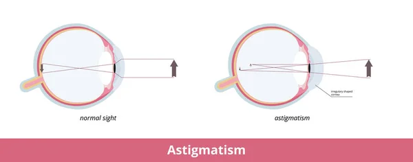 Αστιγματισμός Μια Κοινή Ατέλεια Στην Καμπυλότητα Του Ματιού Που Προκαλεί — Διανυσματικό Αρχείο