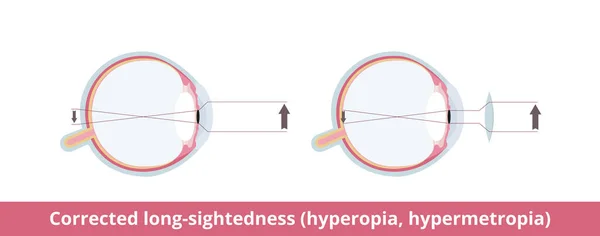 Διορθωμένη Διορατικότητα Υπερμετρωπία Υπερμετρωπία Κατάσταση Των Ματιών Επηρεάζει Την Ικανότητα — Διανυσματικό Αρχείο