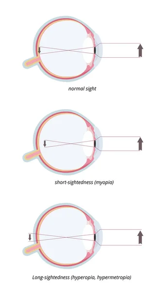 Μυωπία Και Υπερμετρωπία Τρεις Συχνές Οφθαλμικές Παθήσεις Φυσιολογική Όραση Μυωπία — Διανυσματικό Αρχείο