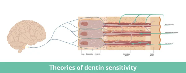 Theories Dentin Sensitivity Visualization Dentin Sensitivity Arising Different Sources Nerves — Vettoriale Stock