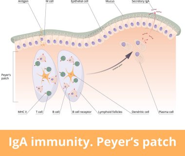 IgA immunity. Peyers patch. Lymphoid follicles of the small intestine generate IgA immune response with B cells, T cells, dendritic cells, and plasma cells secreting IgA.
