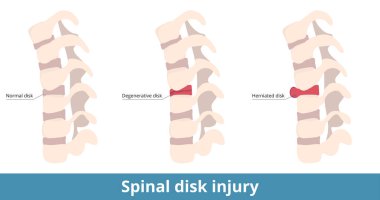 Spinal disk injury. The herniated disk causes pain, numbness, or weakness, and the degenerative disk results as dry out or cracking.  Causes of spinal pain and damage.
