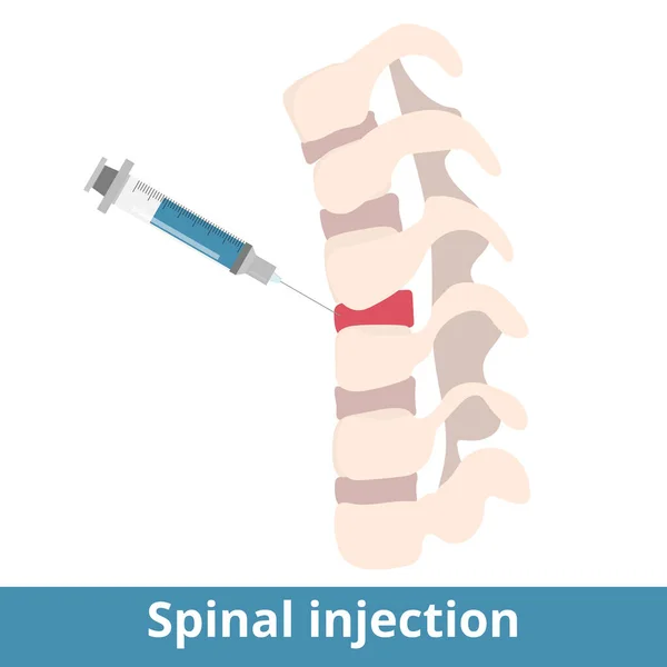 Spinal Injection Spinal Injections Can Performed Diagnose Source Pain Treatment —  Vetores de Stock