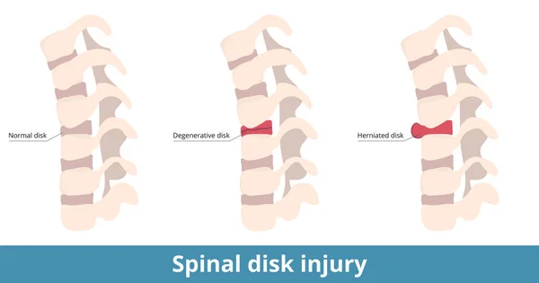 Spinal Disk Injury Herniated Disk Causes Pain Numbness Weakness Degenerative — Wektor stockowy