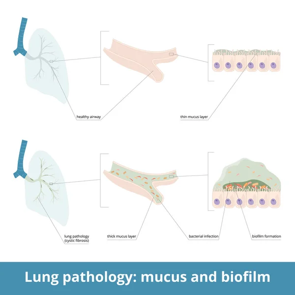 Patología Pulmonar Común Mucosidad Excesiva Las Enfermedades Fibrosis Quística Pueden — Archivo Imágenes Vectoriales