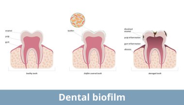 Dental biofilm. Biofilm covers teeth and causes enamel desolvation, inflammation of a gum and pulp. Biofilm on a tooth damages dental tissues, provokes abscess formation. clipart