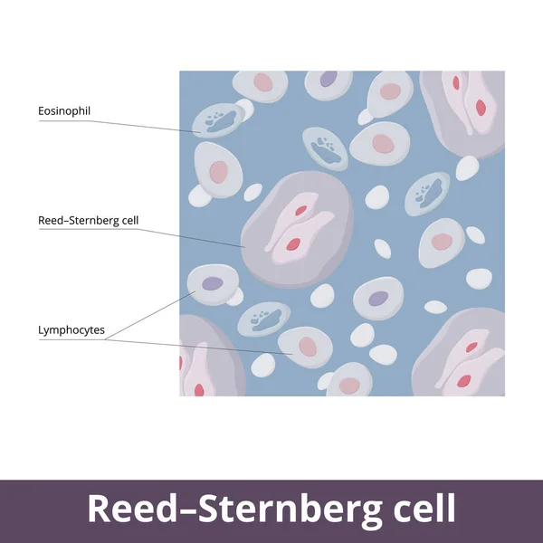 リーデスターバーグ ホジキンリンパ腫患者の生検で見つかった巨大な細胞 血液癌のための一般的な細胞 好酸球 リンパ球 リードSternberg細胞 — ストックベクタ