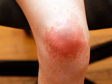 Kaynamış çay suyundan yanmış insan derisi kırmızı iz bırakır.