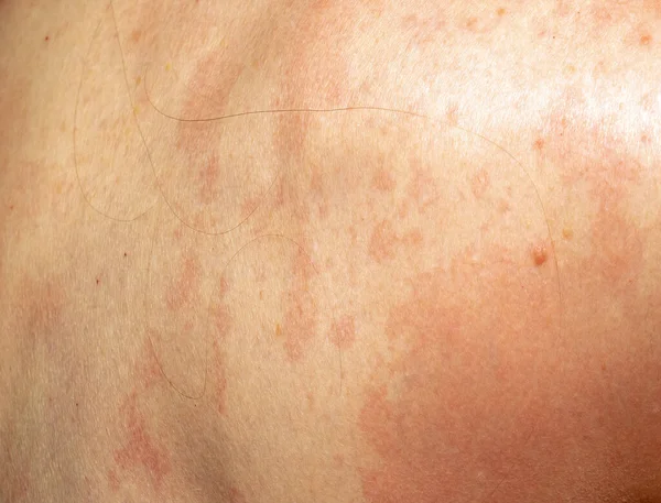 银屑病健康状况红斑皮肤背面 — 图库照片