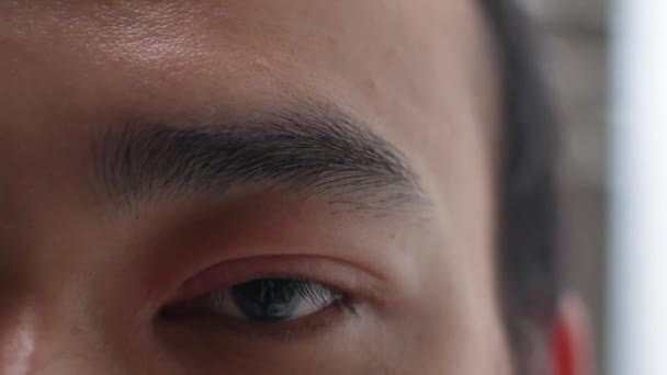 Close Man Eye Being Hordeolum Chalazion Asian Man Eye Closeup — Vídeo de stock