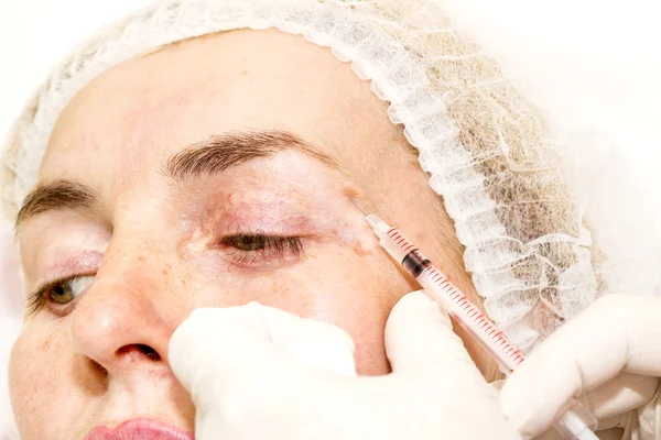 Kosmetische Behandlung mit Botox-Injektion — Stockfoto