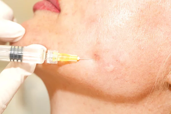 Kosmetisk behandling med botox injektion — Stockfoto