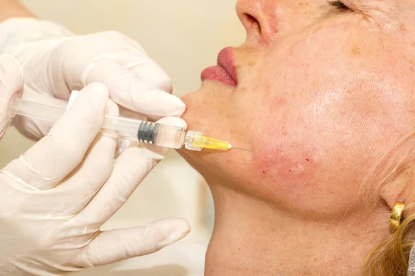 Trattamento cosmetico con iniezione di botox — Foto Stock