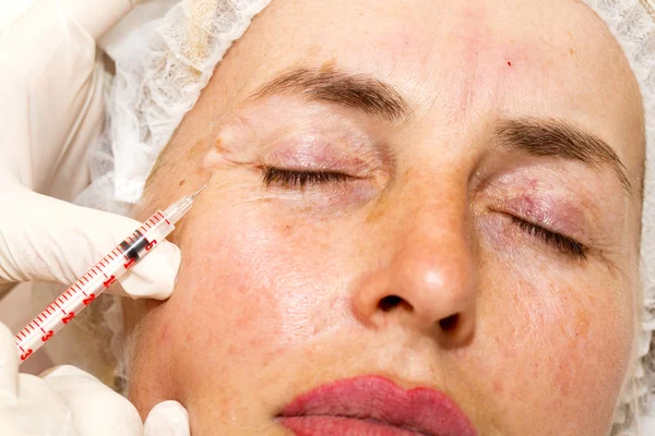 Kosmetisk behandling med botox injektion - Stock-foto
