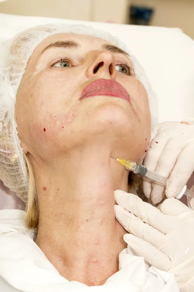 Kosmetische Behandlung mit Botox-Injektion — Stockfoto