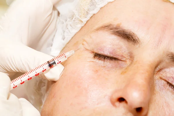 Cosmetic treatment with botox injection — Stock Photo, Image