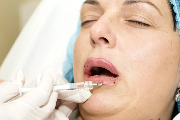 Kosmetisk behandling med botox injektion — Stockfoto