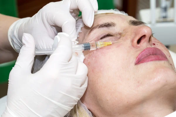 Tratamento cosmético com injeção de botox — Fotografia de Stock