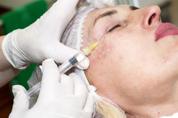 Tratamento cosmético com injeção de botox — Fotografia de Stock