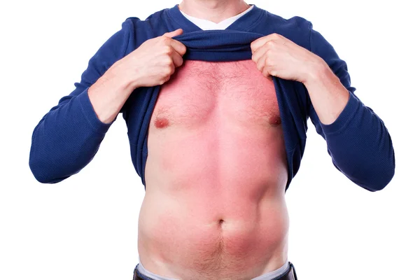 Homem com uma queimadura solar — Fotografia de Stock