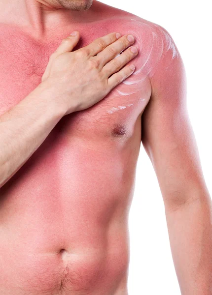 Man with a sunburn — Stock Photo, Image