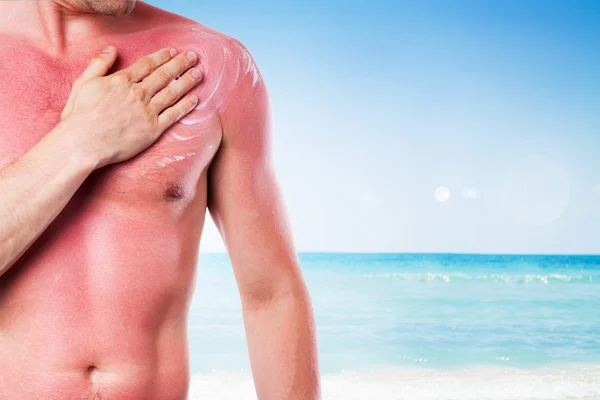 Hombre con una quemadura solar — Foto de Stock