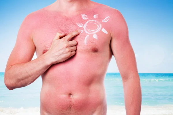 Man with a sunburn — Stock Photo, Image