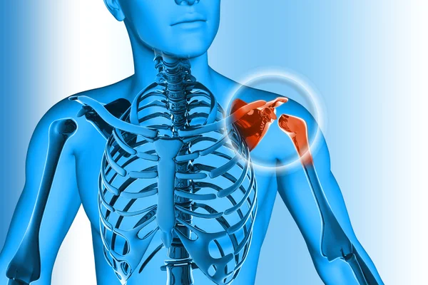 omuz ağrısı - zarar travma